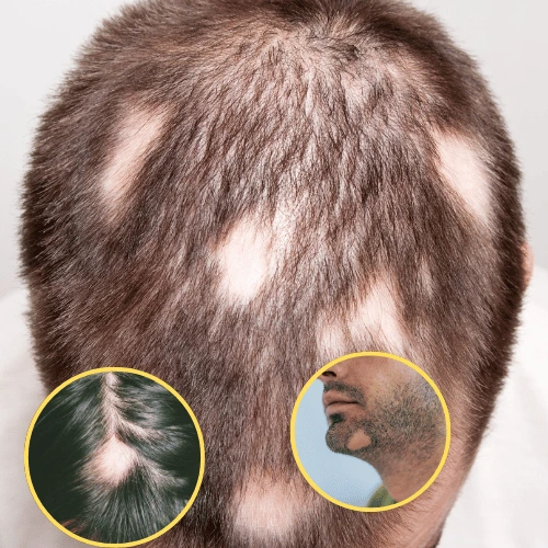 alopecia Areata