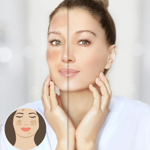 melasma or pigmentation