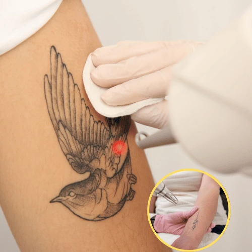 tattoo removal