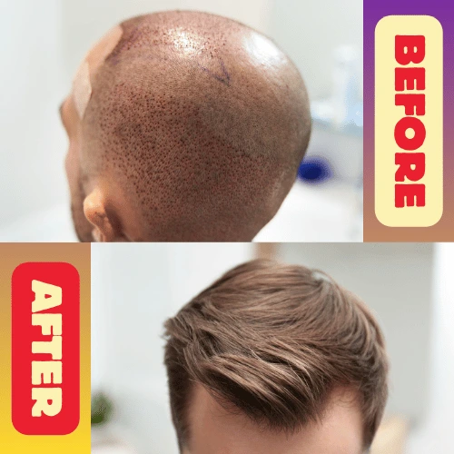hair transplant