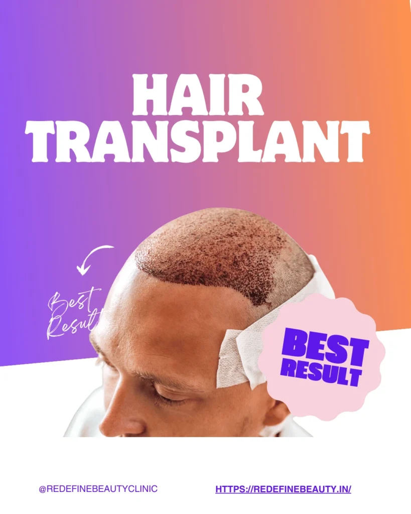 Hair transplant timing